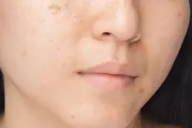 皮肤有斑为什么总是弄不掉？如何有效的科学淡斑？图片