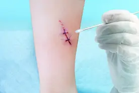 疤痕护理技巧，让你的疤痕不再明显！图片