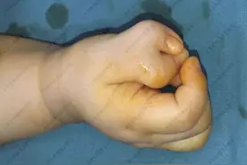 先天性双手大拇指多指畸形，家长奔溃大哭，6指重构手术矫形成功图片