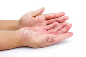 反复出现手脱皮，或是这5个因素导致的，要及时治疗，别忽视图片