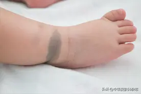 孩子身上有几块咖啡色斑，要不要紧？图片