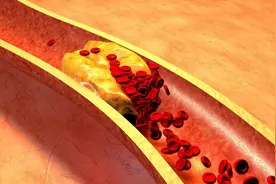 血液粘稠怎么调理好？医生提醒：做好这4件事，有助于血液畅通图片