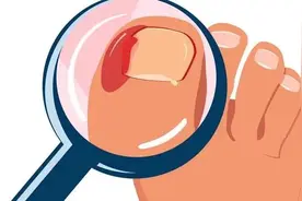 痛到灵魂出窍的“甲沟炎”，是怎么找上门的？图片