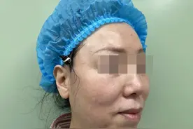 天津64岁女士做了大拉皮，第1天，10天全程实录，像换了一张脸图片