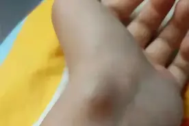 腱鞘囊肿的特效针灸治疗图片