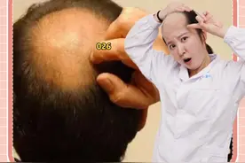 用了米诺地尔不仅没长头发，而且脱发变本加厉？我骗你们了？#防脱生发 #健康科普 #掉发 #米诺地尔 