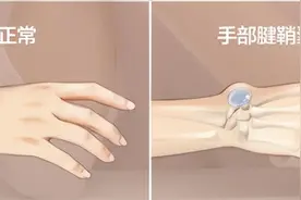 手腕子上有个筋包，咋办？图片