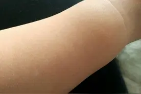 手臂上出现小白点是什么?图片