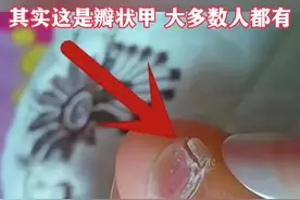 纯种汉族血统的人小脚趾甲才会分成两瓣？医学称为瓣状甲。图片