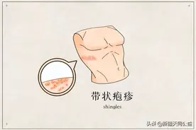 有一种剧痛叫“带状疱疹”，许多人查出艾滋都是因为它！图片