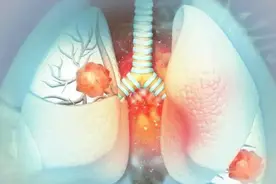 牛奶是肺结节“加速器”？忠告：这4类食物，肺结节患者需节制图片