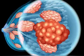 一文了解，乳腺癌的分级分型图片