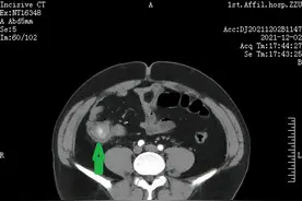 “伪装的粪石”——在郑大一附院进行的一例特殊的盲肠隆起型病变内镜下治疗图片