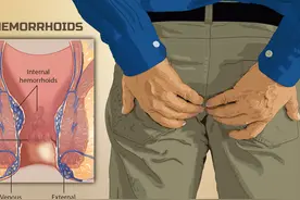 “菊花”残，满地伤，“10男9痔”的痔疮，却是人类进步的标志图片