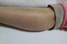 一到秋冬，每次脱裤子时，腿上就掉下很多白屑，这是怎么回事儿？图片