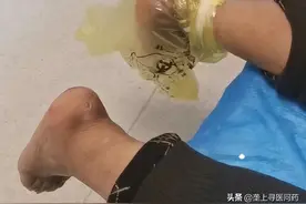 中山医“声”：jiojio烂了怎么办？神奇臭氧帮大忙图片