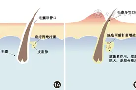 寻常痤疮基层诊疗指南（2023年）图片