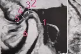 颞下颌关节解剖、正常MRI表现图片