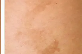 这种斑会有伴发肿瘤的危险！一定不可大意图片