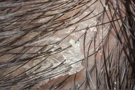 头皮上，总是长疙瘩和脓包，是怎么了？提醒：可能是4种疾病警报图片