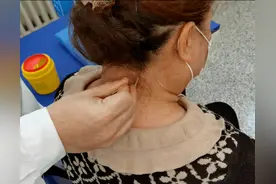 针灸——颈椎病一针疗法图片