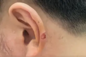 男子理发时耳朵被剪掉一块肉，当事人：理发店只付了200元医药费，店长：耳朵受伤而已，不会影响生活图片