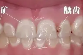 牙齿脱矿不处理可以吗？图片
