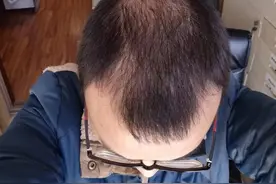 秃顶、脱发图片