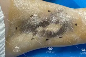 手术都不能根治狐臭，无创治疗能做到吗？图片