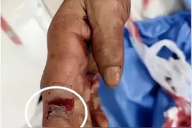 冬天不见蛇？浙江一老伯被毒蛇咬伤！医生：冬天的蛇毒性最大！图片