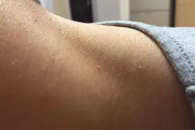 脖子上的“小肉粒”是什么？能用手揪掉吗？了解3个伤脖子的习惯图片