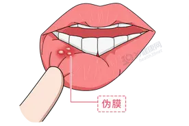 有一种剧痛叫“口腔溃疡”：只补充维生素不管用，这几种药更靠谱图片