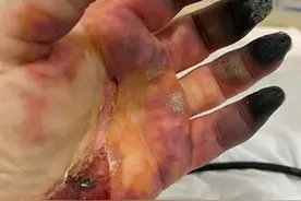 一个英国女人手指碳化病变，被截掉8根，仍乐观面对生活图片