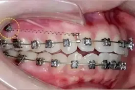 正畸害怕打骨钉？专家：别担心！只有这些情况需要打图片