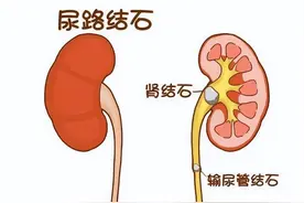 一个治结石非常好用的中药方，胆、肾、膀胱结石都可用，疗效迅速图片