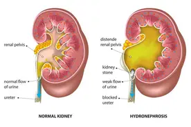 肾结石患者，饮食要注意这6个禁忌，以免加重肾结石图片