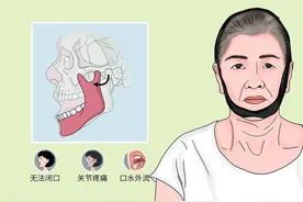 科普：下巴掉了，该如何应对图片