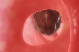 肠息肉会诱发肠癌吗？进行手术后，这件事可千万别忽略，以免复发图片