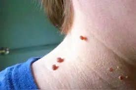 脖子和腋下的“小肉粒”是什么？能不能用手抠掉呢？早看早了解图片