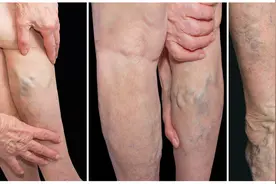 血管外科：微创精准治疗下肢静脉曲张图片