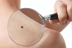 人身上的痣有好有坏，什么样的痣是“坏痣”？提醒：千万别用手抠图片