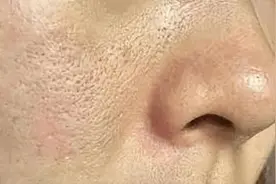 「科普」4招解决毛孔粗大问题图片