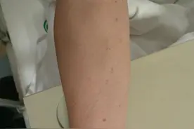 看牙竟发现血液病！这位口腔科医生救人一命图片