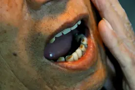 300块的牙套和三万块的种植牙，到底有什么区别？是智商税吗？图片