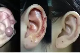 打耳洞耳朵增生疙瘩怎么办？耳洞增生的疙瘩应该怎么治疗？图片