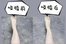 考虑了1年终于下定决心做了大腿环吸图片