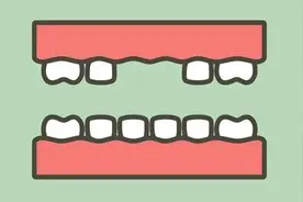 「缺牙」不但影响口腔，还让预期寿命缩短了11.7年图片