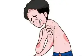 牛皮癣四肢红斑点状散发致关节肿胀变形，应当如何治疗效果好呢？图片