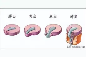 治疗腰椎间盘脱出症的常用穴位（附详细图解）图片