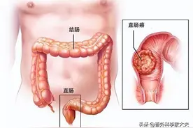 直肠癌T3N2患者，能治好吗？图片